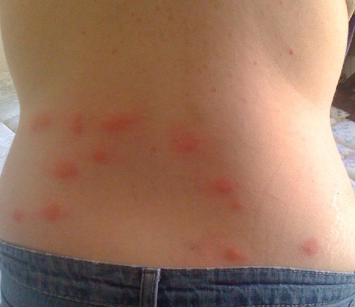 picture of bed bug bites on skin