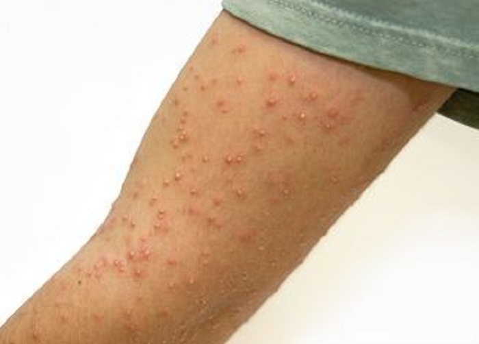 BED BUG BITES PICTURES Bed bug bites pictures on humans â€“ BED BUG ...