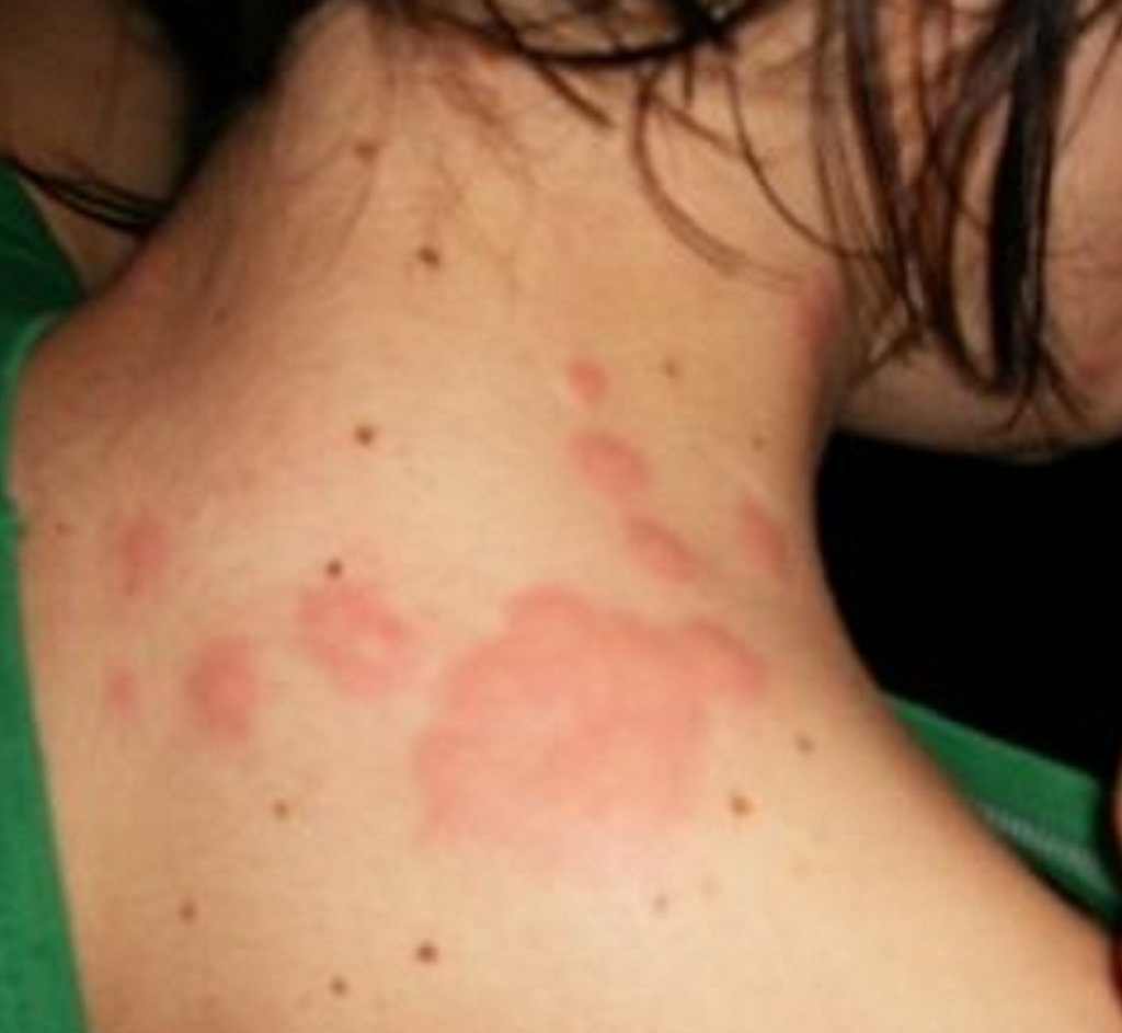 Bed Bug Bites On Black People Skin Bed bug bites: picture of the