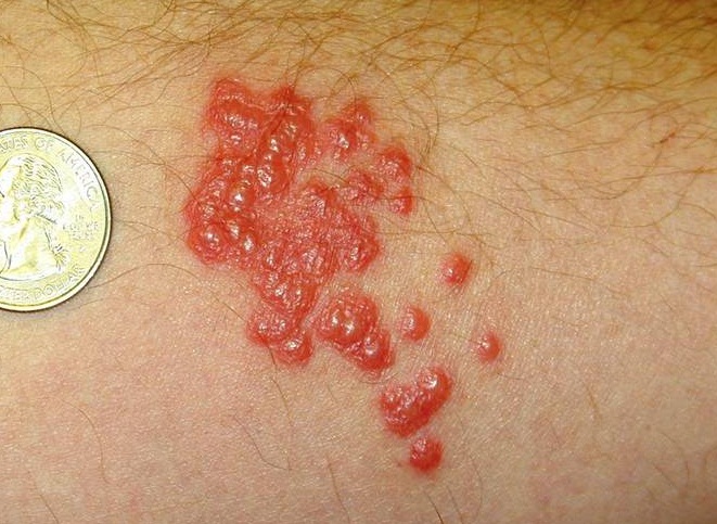 Google Images Bed Bug Bites | imagebasket.net