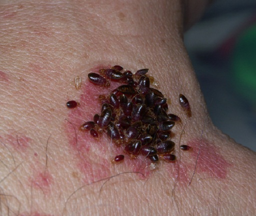 ... HOW TO PREVENT BED BUGS â€“ BED BUG BITES and BED BUG TREATMENT