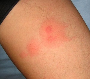 ... the bite is indicative of a strong allergic reaction to bed bug bites