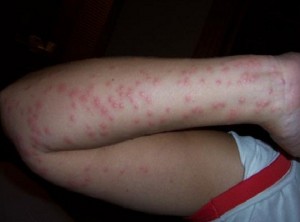 BED BUG BITES PICTURES BED BUG BITES PICTURES
