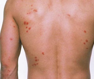 BED BUGS BITE BED BUGS BITE PHOTO