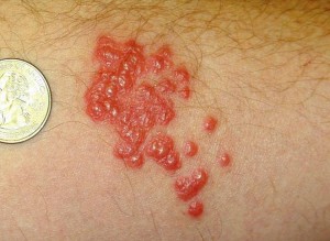 BEDBUG BITES | BEDBUG BITE