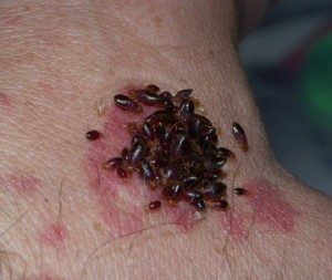 HOW TO PREVENT BED BUGS | Bed bugs feeding on hand.