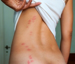 PICTURES OF BED BUG BITES | Bedbug bites on the body.